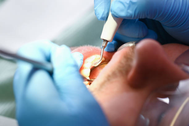 Best Knocked-Out Tooth (Avulsed Tooth) Treatment in Sauk City, WI